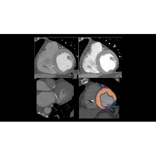 КТ аппарат GE Revolution CT